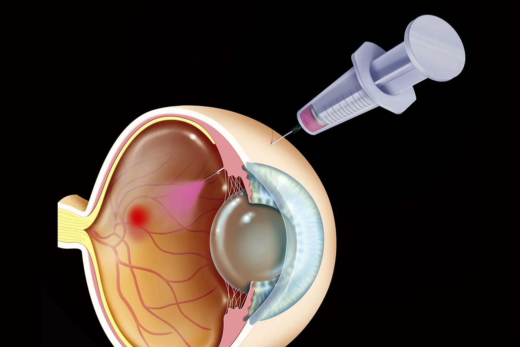 How Injections and Lasers Work