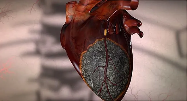 on Key Facts About Heart Attacks
