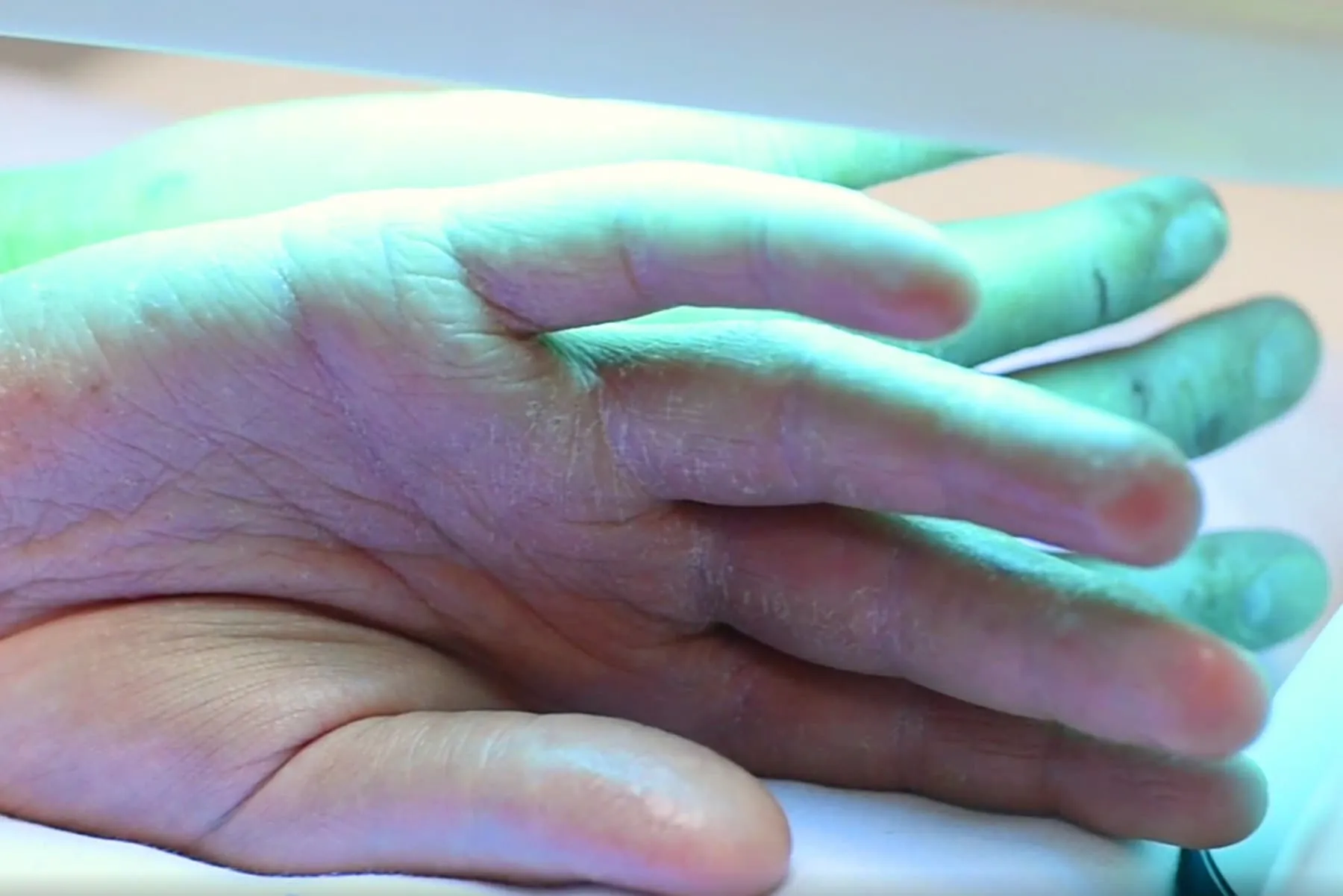 Phototherapy Treatment