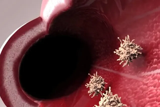 How UC Inflames Your Large Intestine