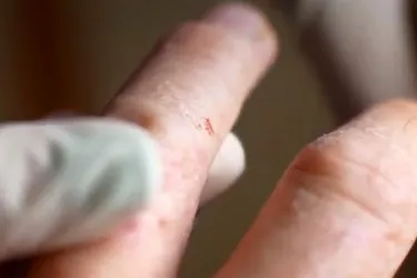 How to Safely Remove Scales