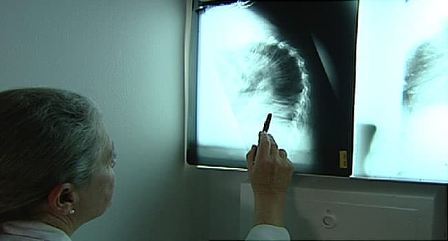 What to Know About Spinal Fractures