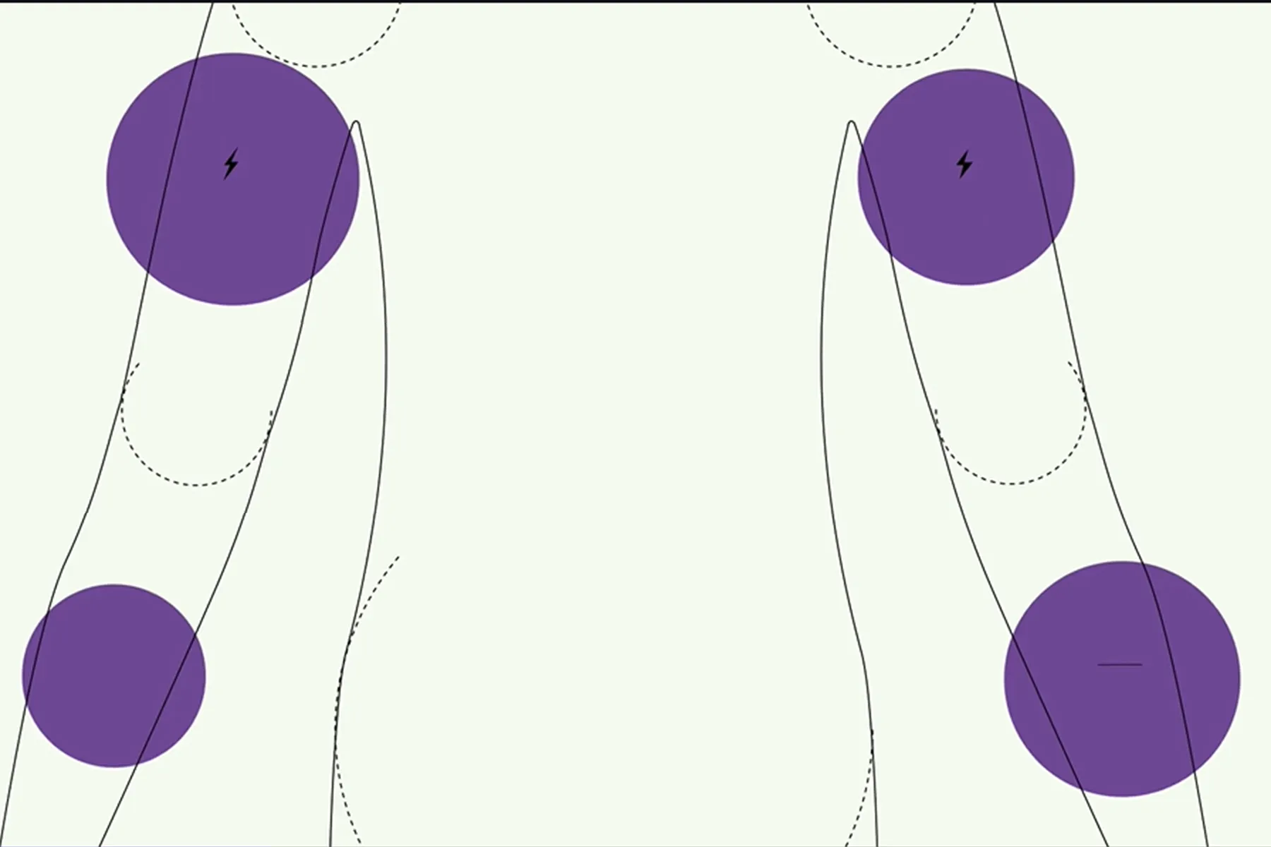 Treating SMA by Targeting One Gene