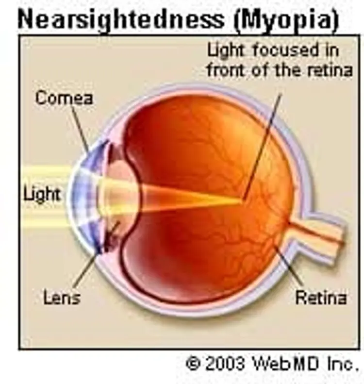 Myopia