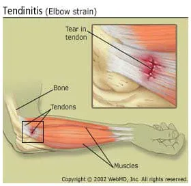 picture of tendinitis