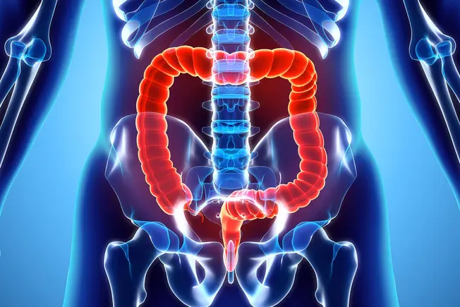 What Should You Know About Ulcerative Colitis?