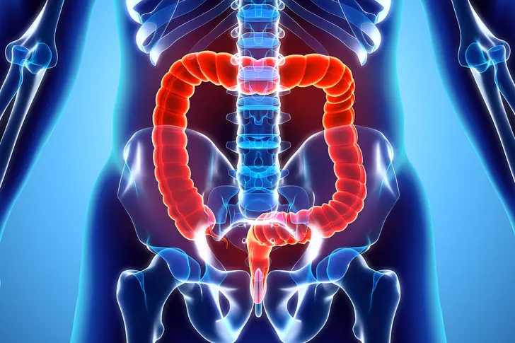 What Should You Know About Ulcerative Colitis?