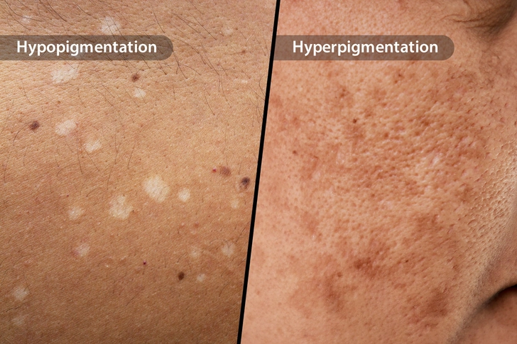 Light or Dark Skin Patches