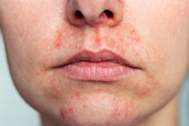  Mouth Rash (perioral dermatitis)