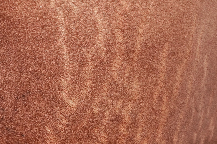 Stretch Marks