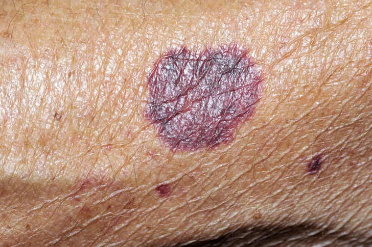 Easy Bruising