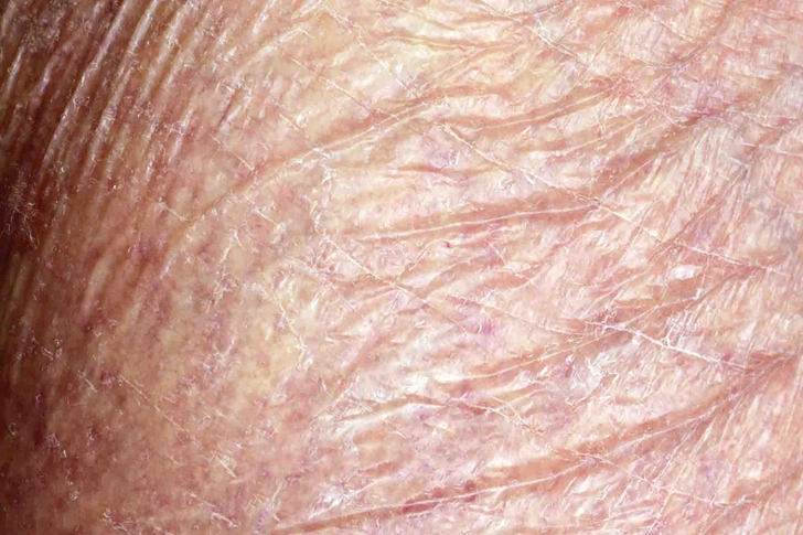  Skin Thinning (Atrophy)