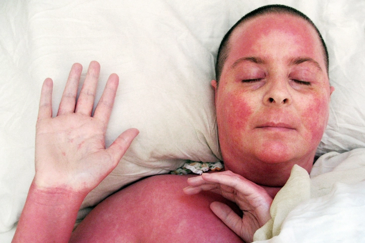 Topical Steroid Withdrawal (TSW)