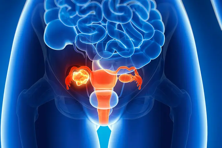 10 Tips on Caring for Yourself With Ovarian Cancer