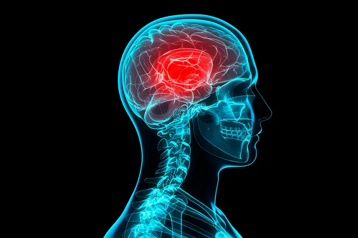 Migraines