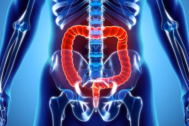 How Your Ulcerative Colitis Is Affected by Diet How Your Ulcerative Colitis Is Affected by Diet
