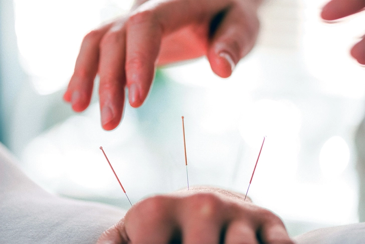 Acupuncture Acupuncture