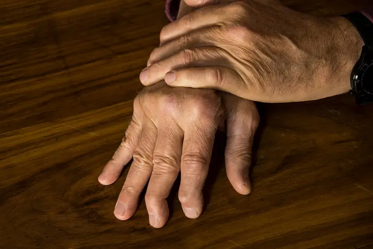 What Is Psoriatic Arthritis? What Is Psoriatic Arthritis?