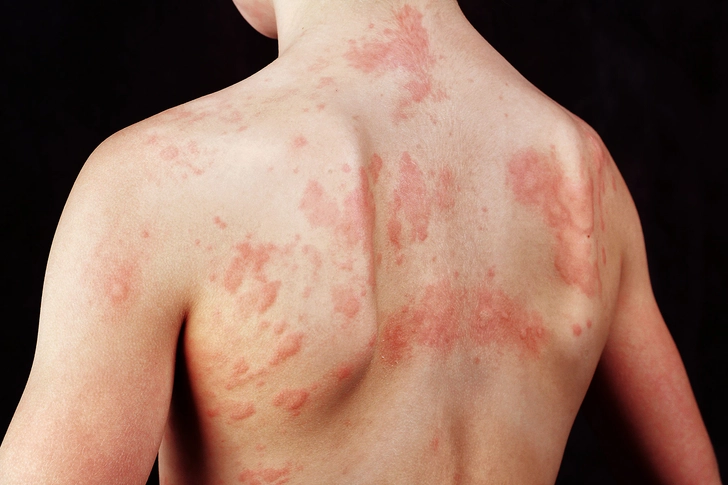 No. 6: Hives No. 6: Hives