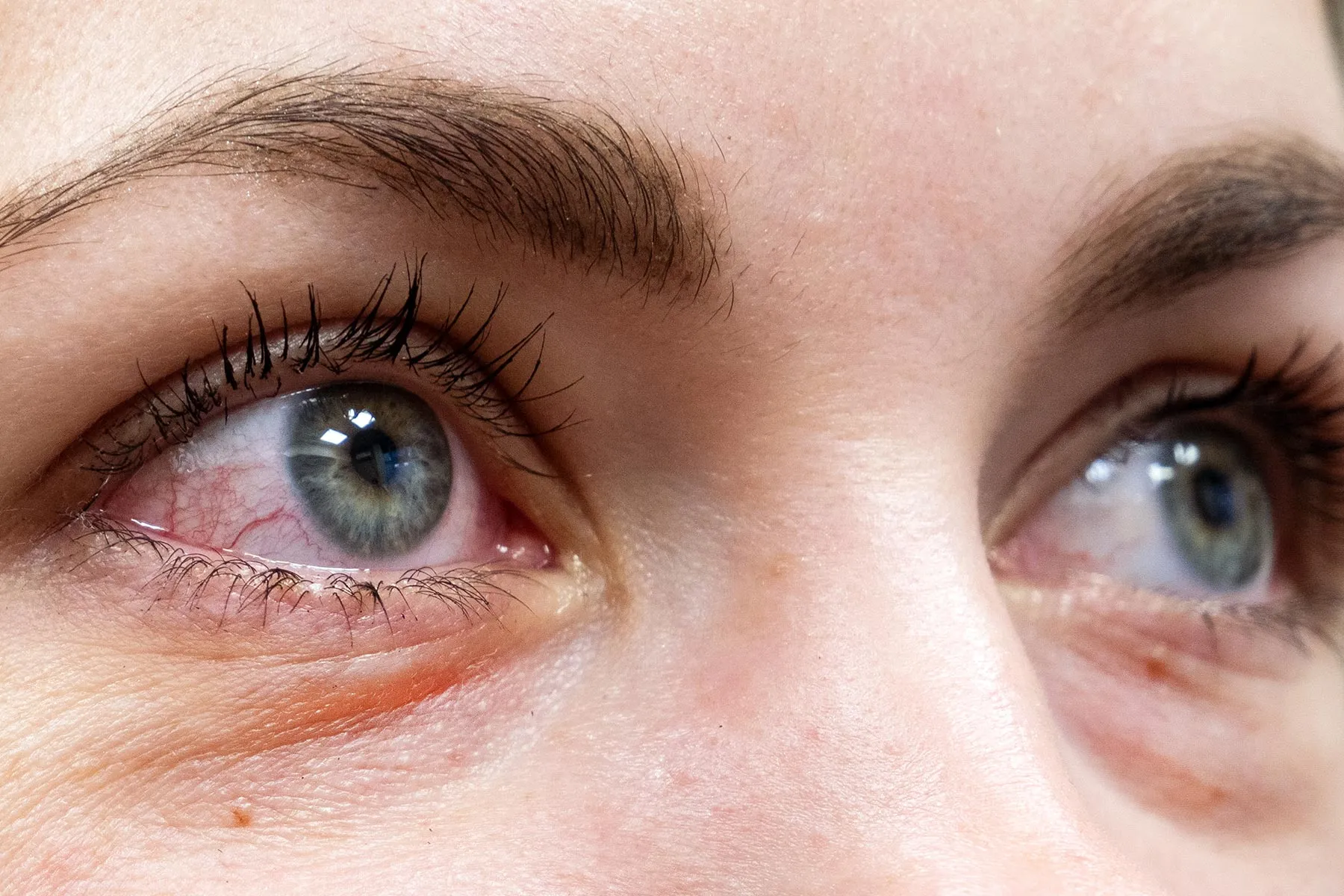 Red And Bloodshot Eyes Common Causes Treatment Red And Bloodshot Eyes Common Causes Treatment
