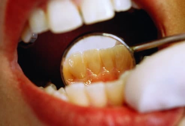 Open Wide and Say 'Whiter Teeth!'