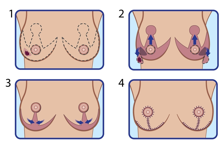 Bilateral Breast Lift