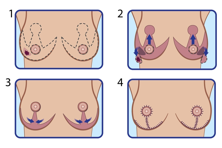 Bilateral Breast Lift Bilateral Breast Lift