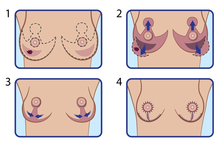 Bilateral Breast Reduction