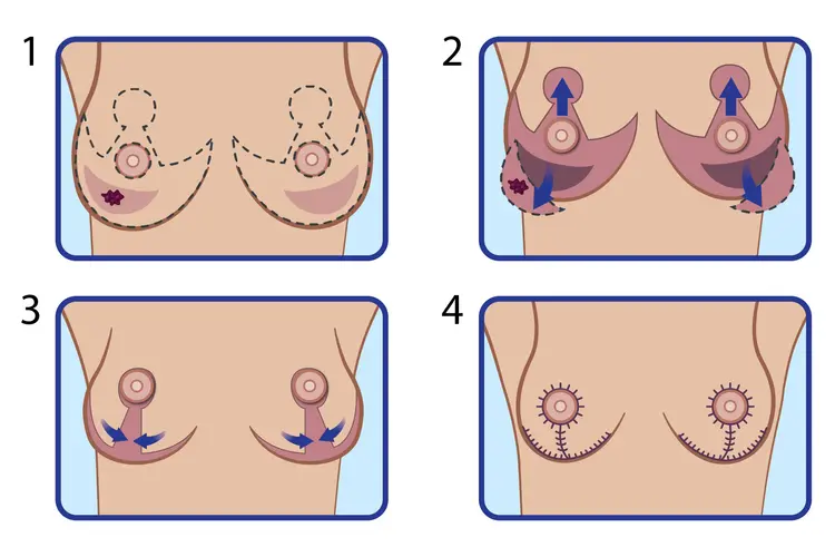 photo of bilateral breast reduction