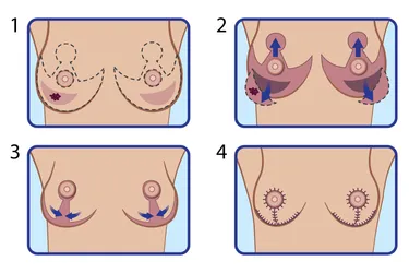There are different types of incisions your surgeon could make, depending on the shape and size of your breasts and how much tissue they need to remove. (Photo credit: WebMD)