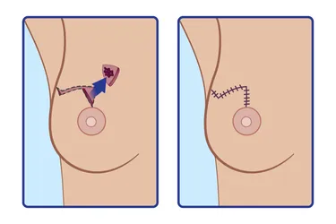 Flap Reconstruction Options