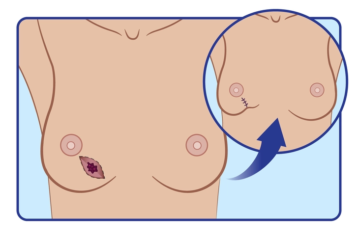 Lumpectomy