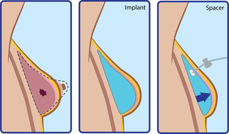 Reconstruction After Total Mastectomy Reconstruction After Total Mastectomy