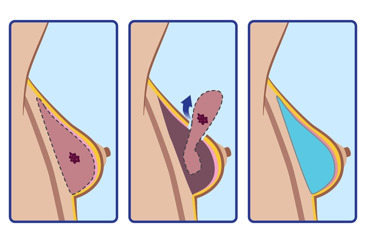 Skin-Sparing Mastectomy