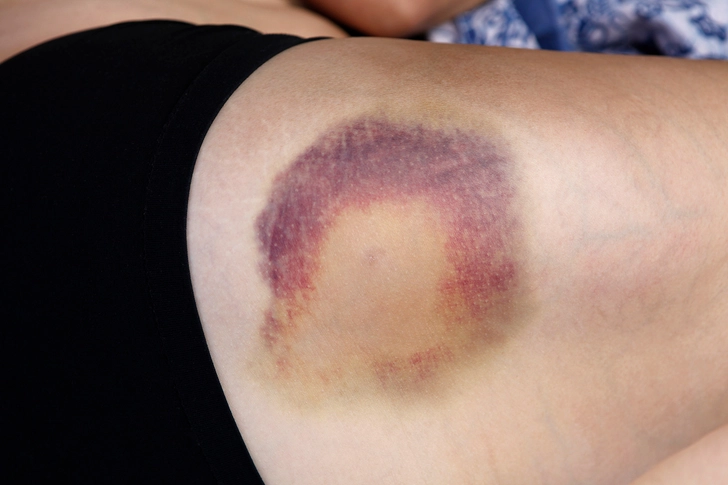 Ehlers-Danlos Syndrome (EDS)