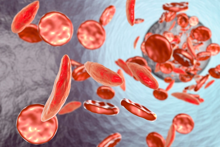Anemia