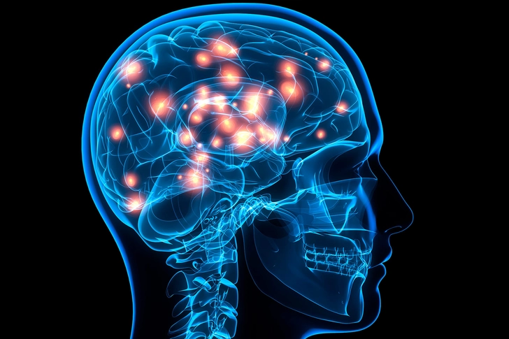 Fibromyalgia