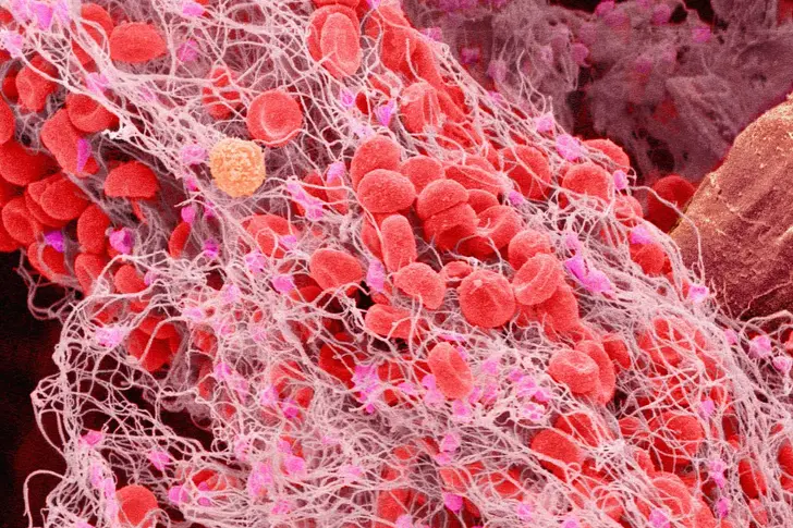 Why Are Fit and Active Athletes at Risk For DVT?