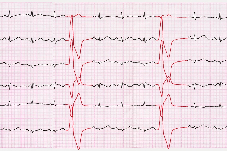 Causes of Heart Palpitations