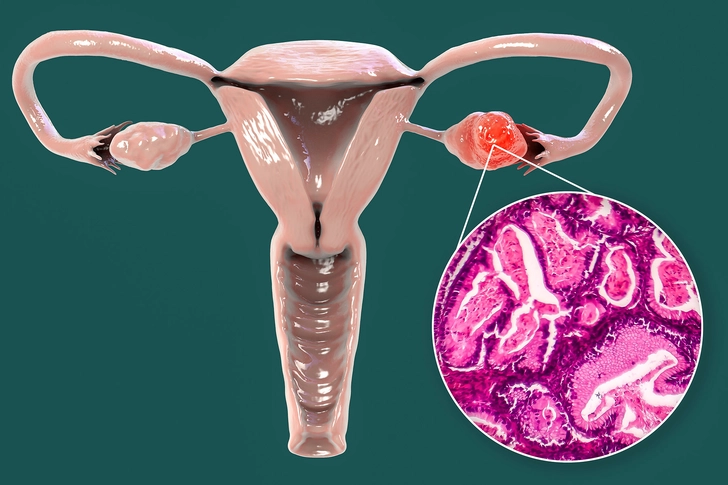 2. Ovarian Cancer Can Return Near or Far