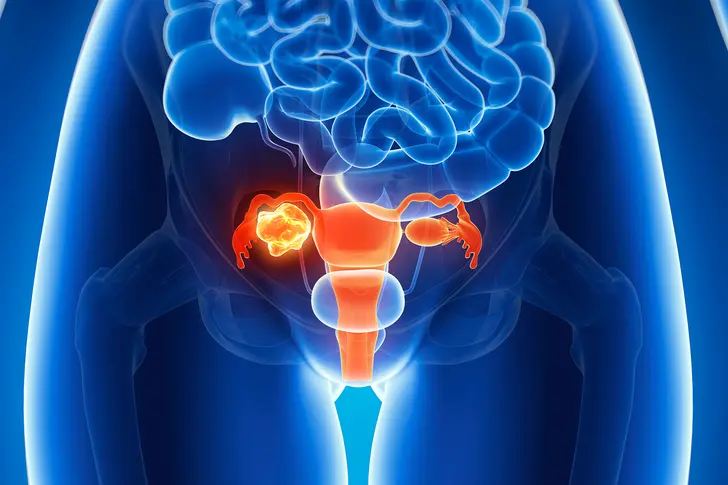 Can Ovarian Cancer Return After Treatment?