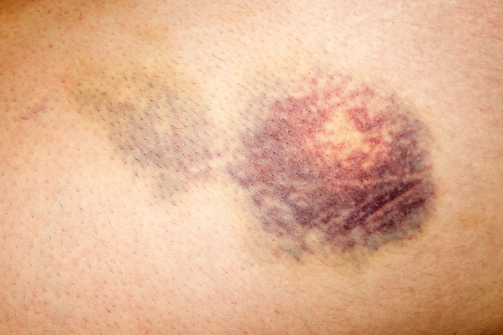 Easy Bleeding and Bruising