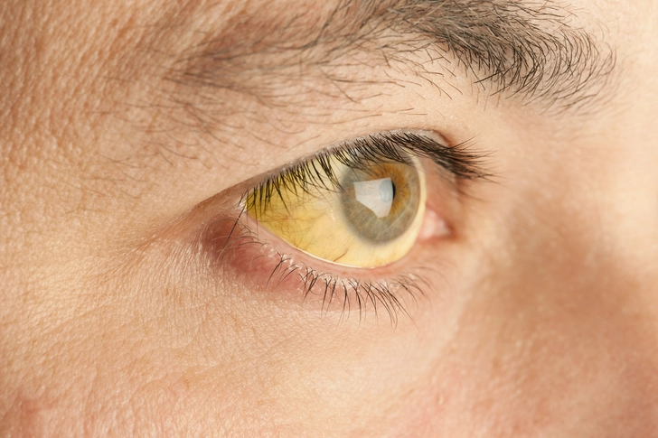 Altered Color in Skin and Eyes