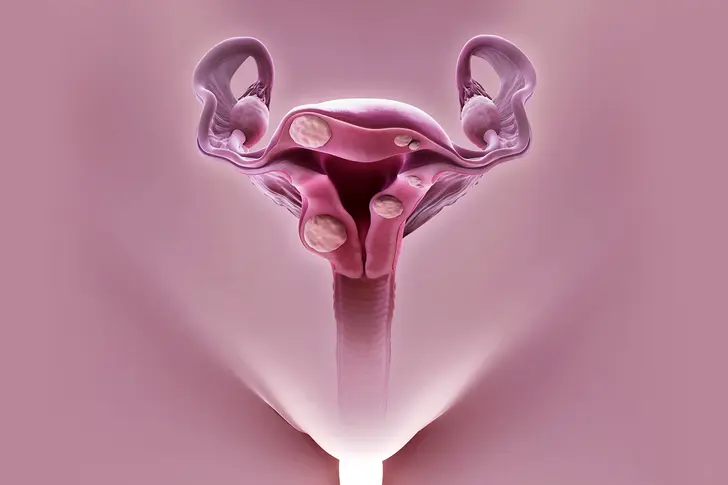 What Are Uterine Fibroids?