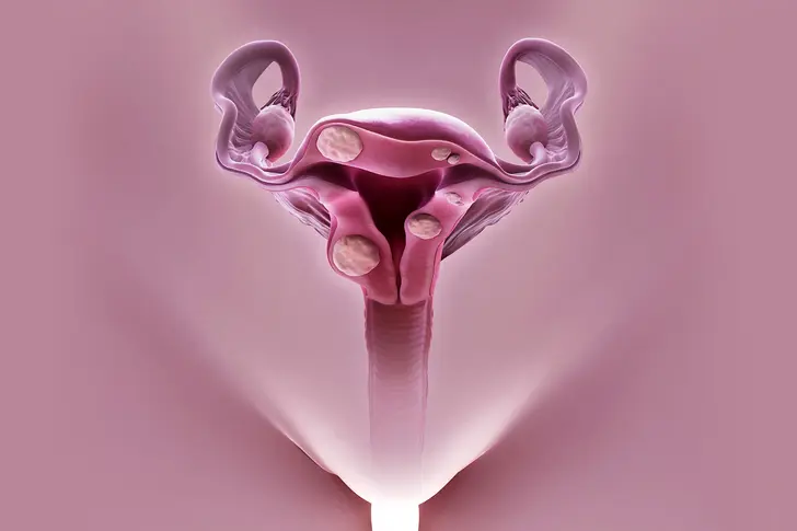 What Are Uterine Fibroids? What Are Uterine Fibroids?