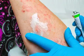 photo of doctor applying lotion on arm