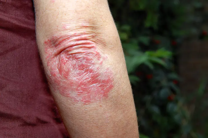 Tips for Women Over 50: Avoiding Psoriasis Triggers