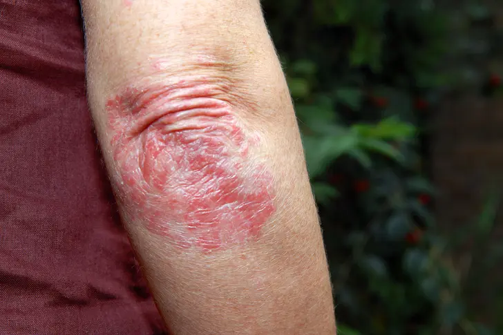 Tips for Women Over 50: Avoiding Psoriasis Triggers Tips for Women Over 50: Avoiding Psoriasis Triggers