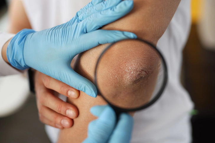 3. They Have Experience With Psoriasis