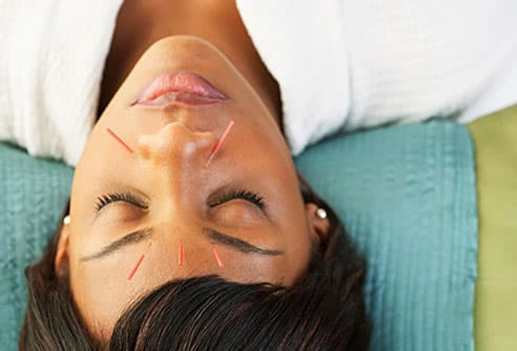 12. Consider Acupuncture